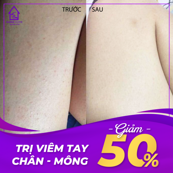 Trị viêm tay