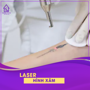 Laser hình xăm