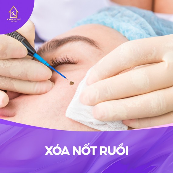 Xoá nốt ruồi bằng Laser