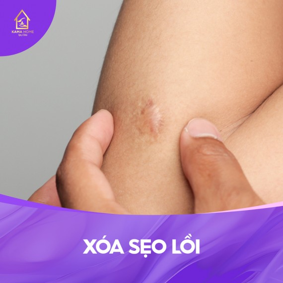 Xoá Sẹo Lồi